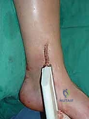 صورة طبية: علاج آفات القبة الكاحلية العظمية الغضروفية بالزرع الذاتي: خبرة الأستاذ الدكتور محمد هطيف في صنعاء