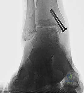 Osteochondral Autograft Transfer for Talar Dome Lesions: An Operative Masterclass