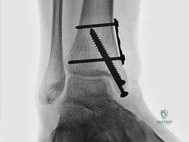 علاج آفات القبة الكاحلية العظمية الغضروفية بالزرع الذاتي: خبرة الأستاذ الدكتور محمد هطيف في صنعاء