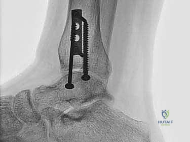 توضيح لآفة غضروفية في الكاحل