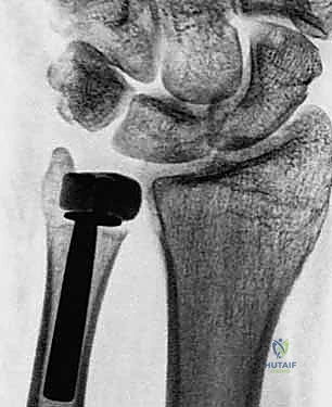 توضيح عظام الساعد والرسغ