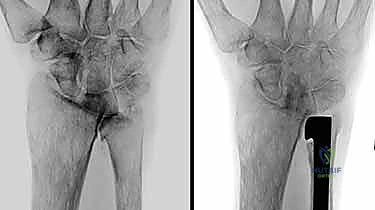 تأثير الكسور السابقة على المفصل