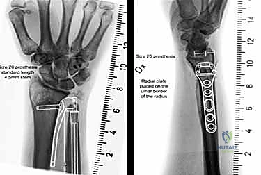 انحشار الزند واحتكاكه بالكعبرة