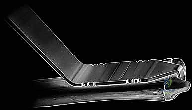 صورة أشعة سينية لمفصل الزند