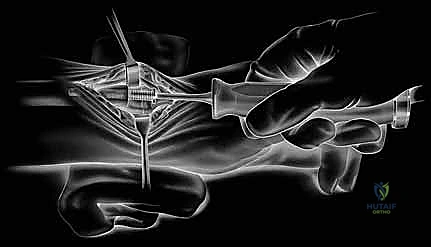 زراعة المفصل الصناعي النهائي