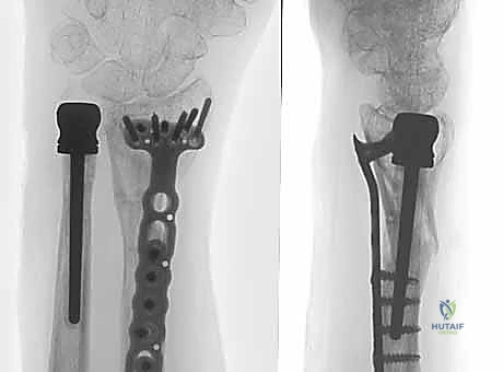 صورة توضيحية لـ جراحة استبدال رأس الزند الصناعي: حل شامل لآلام وعدم استقرار مفصل الرسغ