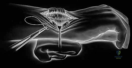 التحضير الجراحي للرسغ