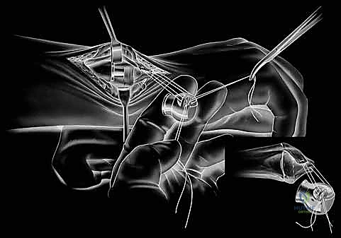 صورة توضيحية لـ جراحة استبدال رأس الزند الصناعي: حل شامل لآلام وعدم استقرار مفصل الرسغ