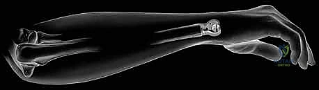 جراحة استبدال رأس الزند الصناعي: حل شامل لآلام وعدم استقرار مفصل الرسغ