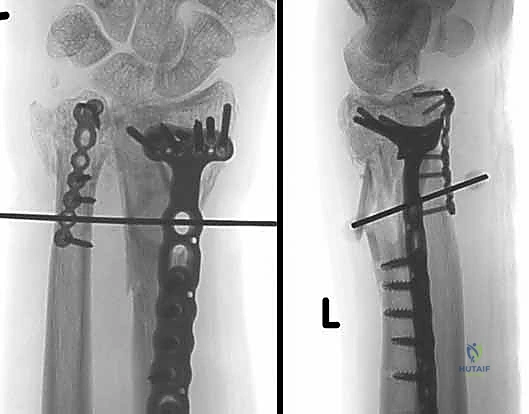 إعادة بناء وخياطة الأربطة