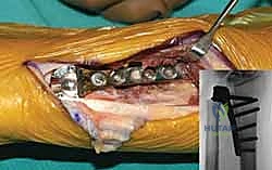 فحص نطاق الحركة للرسغ