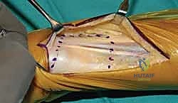 تحضير قناة عظم الزند