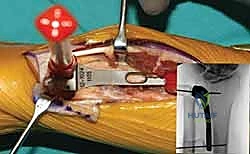 إغلاق الجرح الجراحي