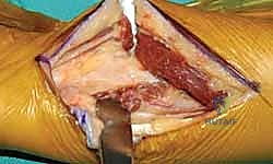 الشق الجراحي وإبعاد الأنسجة