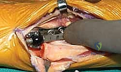 تجربة حجم المفصل الصناعي