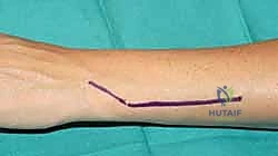 أنواع المفاصل الصناعية