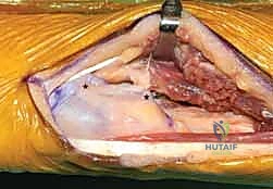 متابعة ما بعد الجراحة بالأشعة