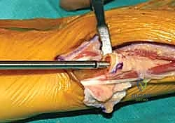 تمارين العلاج الطبيعي للرسغ