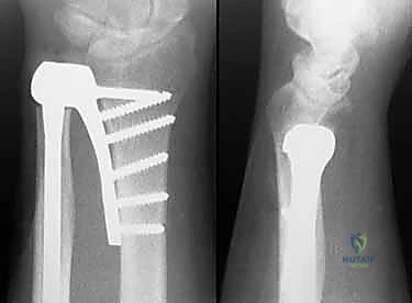تصميم المفصل الصناعي الحديث