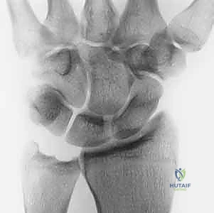 Arthroscopic TFCC Débridement & Ulnar Shortening: An Intraoperative Masterclass