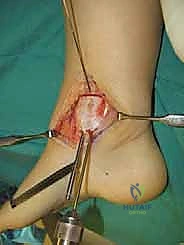 صورة طبية: إعادة بناء آفة الكاحل الغضروفية العظمية الكبيرة بالطعم الخيفي الهيكلي: دليل شامل للمرضى مع الأستاذ الدكتور محمد هطيف