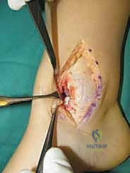 الأوعية الدموية المغذية للكاحل