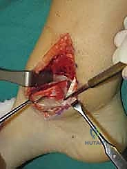 تصوير مقطعي محوسب للكاحل