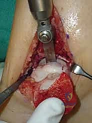 تلف غضروف الكاحل