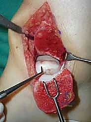 تشريح مفصل الكاحل وآفات الغضروف