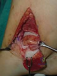 صورة توضيحية لـ إعادة بناء آفة الكاحل الغضروفية العظمية الكبيرة بالطعم الخيفي الهيكلي: دليل شامل للمرضى مع الأستاذ الدكتور محمد هطيف