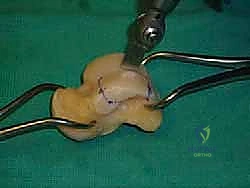 التشريح العظمي للكاحل