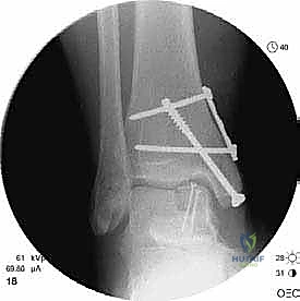 صورة توضيحية لـ إعادة بناء آفة الكاحل الغضروفية العظمية الكبيرة بالطعم الخيفي الهيكلي: دليل شامل للمرضى مع الأستاذ الدكتور محمد هطيف