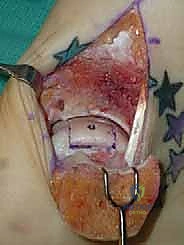 صورة توضيحية لـ إعادة بناء آفة الكاحل الغضروفية العظمية الكبيرة بالطعم الخيفي الهيكلي: دليل شامل للمرضى مع الأستاذ الدكتور محمد هطيف