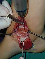 صورة توضيحية لـ إعادة بناء آفة الكاحل الغضروفية العظمية الكبيرة بالطعم الخيفي الهيكلي: دليل شامل للمرضى مع الأستاذ الدكتور محمد هطيف