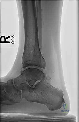 صورة طبية: إعادة بناء آفة الكاحل الغضروفية العظمية الكبيرة بالطعم الخيفي الهيكلي: دليل شامل للمرضى مع الأستاذ الدكتور محمد هطيف