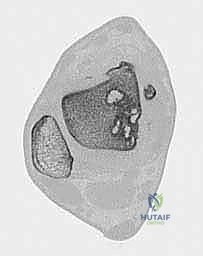 صورة طبية: إعادة بناء آفة الكاحل الغضروفية العظمية الكبيرة بالطعم الخيفي الهيكلي: دليل شامل للمرضى مع الأستاذ الدكتور محمد هطيف