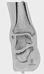 صورة طبية: إعادة بناء آفة الكاحل الغضروفية العظمية الكبيرة بالطعم الخيفي الهيكلي: دليل شامل للمرضى مع الأستاذ الدكتور محمد هطيف