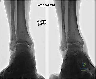 صورة طبية: إعادة بناء آفة الكاحل الغضروفية العظمية الكبيرة بالطعم الخيفي الهيكلي: دليل شامل للمرضى مع الأستاذ الدكتور محمد هطيف