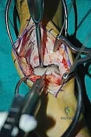 صورة طبية: إعادة بناء آفة الكاحل الغضروفية العظمية الكبيرة بالطعم الخيفي الهيكلي: دليل شامل للمرضى مع الأستاذ الدكتور محمد هطيف