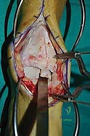 صورة طبية: إعادة بناء آفة الكاحل الغضروفية العظمية الكبيرة بالطعم الخيفي الهيكلي: دليل شامل للمرضى مع الأستاذ الدكتور محمد هطيف