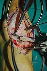 صورة طبية: إعادة بناء آفة الكاحل الغضروفية العظمية الكبيرة بالطعم الخيفي الهيكلي: دليل شامل للمرضى مع الأستاذ الدكتور محمد هطيف