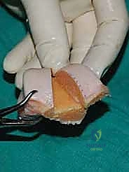 صورة طبية: إعادة بناء آفة الكاحل الغضروفية العظمية الكبيرة بالطعم الخيفي الهيكلي: دليل شامل للمرضى مع الأستاذ الدكتور محمد هطيف