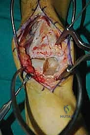 صورة طبية: إعادة بناء آفة الكاحل الغضروفية العظمية الكبيرة بالطعم الخيفي الهيكلي: دليل شامل للمرضى مع الأستاذ الدكتور محمد هطيف