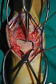 صورة طبية: إعادة بناء آفة الكاحل الغضروفية العظمية الكبيرة بالطعم الخيفي الهيكلي: دليل شامل للمرضى مع الأستاذ الدكتور محمد هطيف