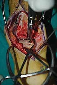 صورة طبية: إعادة بناء آفة الكاحل الغضروفية العظمية الكبيرة بالطعم الخيفي الهيكلي: دليل شامل للمرضى مع الأستاذ الدكتور محمد هطيف