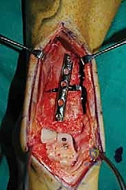 صورة طبية: إعادة بناء آفة الكاحل الغضروفية العظمية الكبيرة بالطعم الخيفي الهيكلي: دليل شامل للمرضى مع الأستاذ الدكتور محمد هطيف
