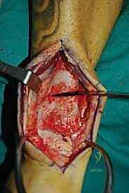 صورة طبية: إعادة بناء آفة الكاحل الغضروفية العظمية الكبيرة بالطعم الخيفي الهيكلي: دليل شامل للمرضى مع الأستاذ الدكتور محمد هطيف
