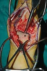 صورة طبية: إعادة بناء آفة الكاحل الغضروفية العظمية الكبيرة بالطعم الخيفي الهيكلي: دليل شامل للمرضى مع الأستاذ الدكتور محمد هطيف