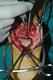 صورة طبية: إعادة بناء آفة الكاحل الغضروفية العظمية الكبيرة بالطعم الخيفي الهيكلي: دليل شامل للمرضى مع الأستاذ الدكتور محمد هطيف