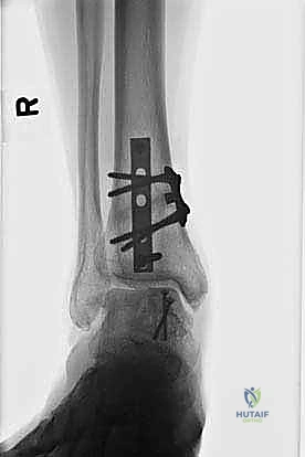 صورة طبية: إعادة بناء آفة الكاحل الغضروفية العظمية الكبيرة بالطعم الخيفي الهيكلي: دليل شامل للمرضى مع الأستاذ الدكتور محمد هطيف